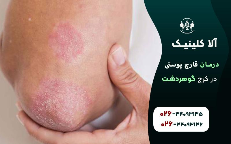 درمان قارچ پوستی در کرج