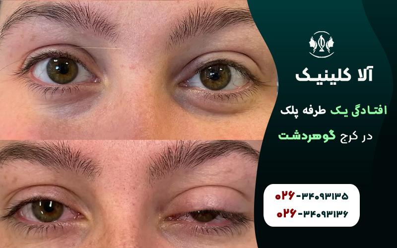علائم و تشخیص افتادگی یک طرفه پلک