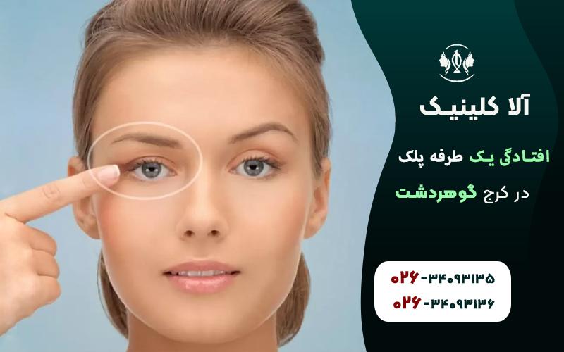 افتادگی یک طرفه پلک