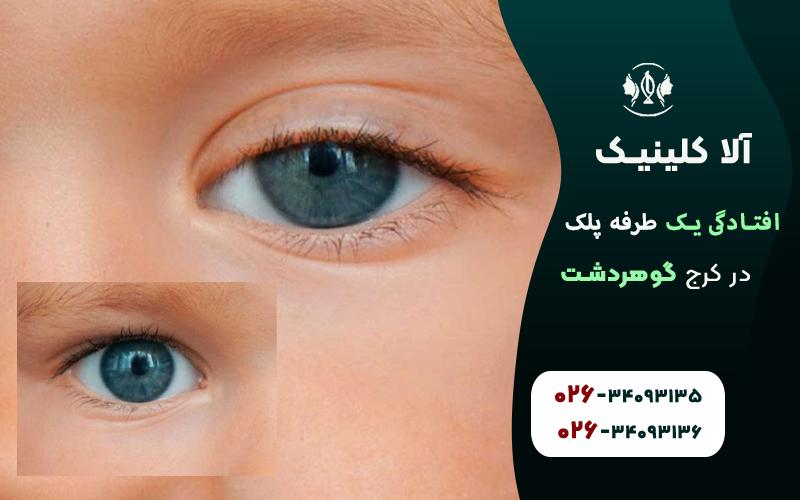 افتادگی یک طرفه پلک