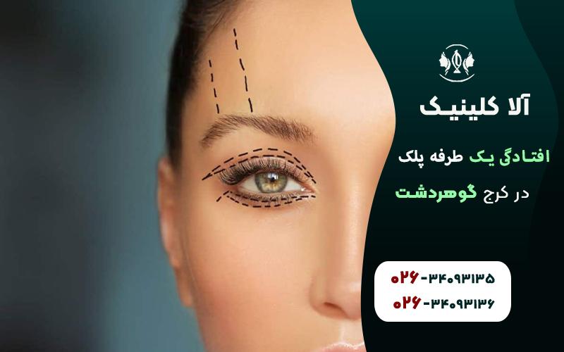 روشهای درمان افتادگی یک طرفه پلک