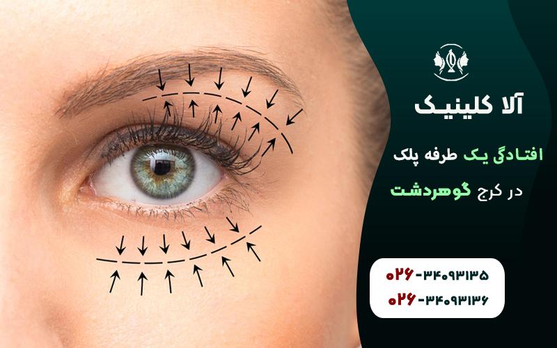 درمان افتادگی یک طرفه پلک