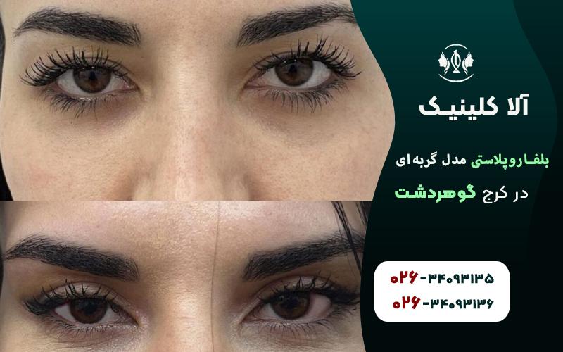 بلفاروپلاستی مدل گربه ای قبل و بعد