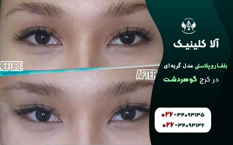 بلفاروپلاستی مدل گربه ای در کرج قبل و بعد