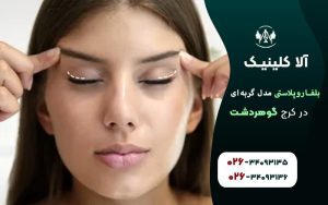 بلفاروپلاستی مدل گربه ای در کرج