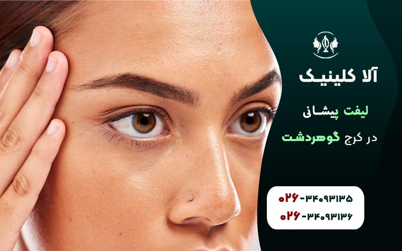 لیفت پیشانی در کرج 