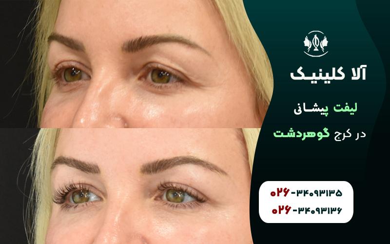  لیفت پیشانی در کرج قبل و بعد