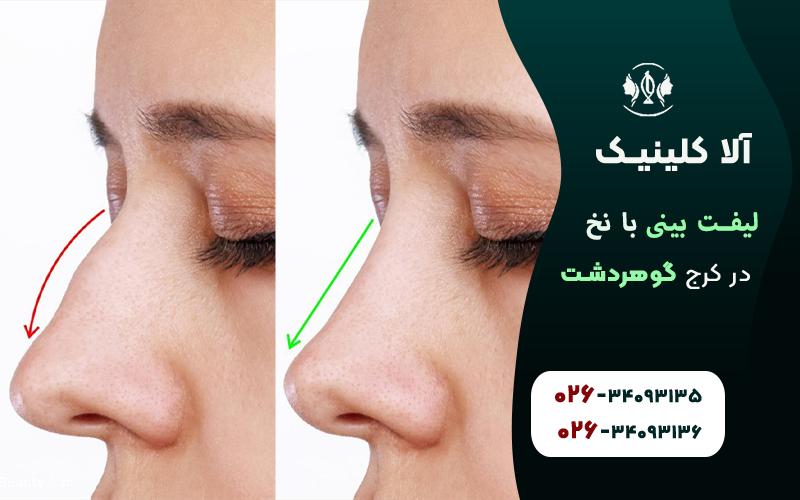 لیفت بینی با نخ در کرج قبل و بعد