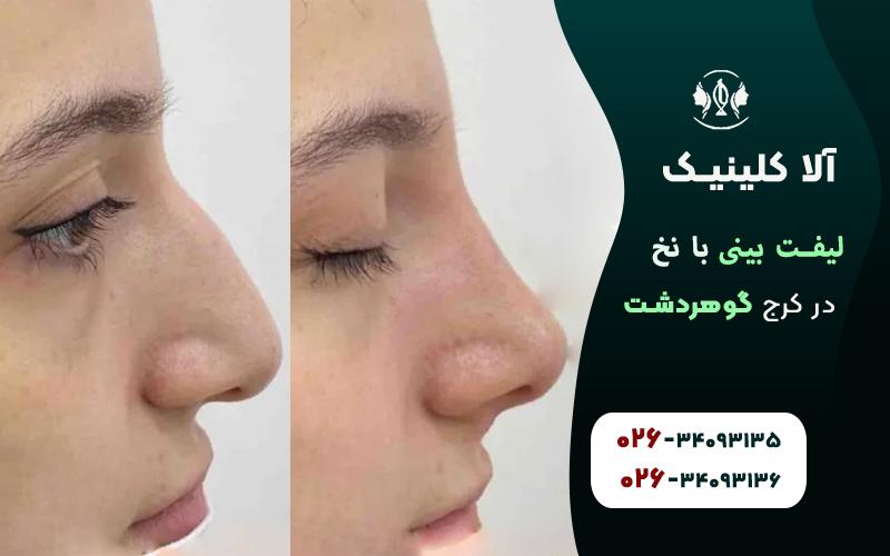 لیفت بینی با نخ قبل و بعد لیفت