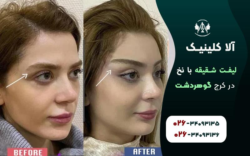 قبل و بعد لیفت شقیقه با نخ در کرج