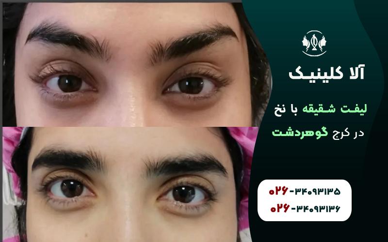 لیفت شقیقه با نخ قبل و بعد