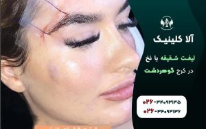 لیفت شقیقه با نخ در کرج