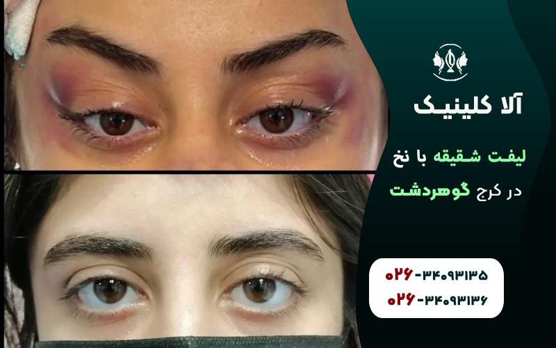 لیفت شقیقه با نخ در کرج قبل و بعد