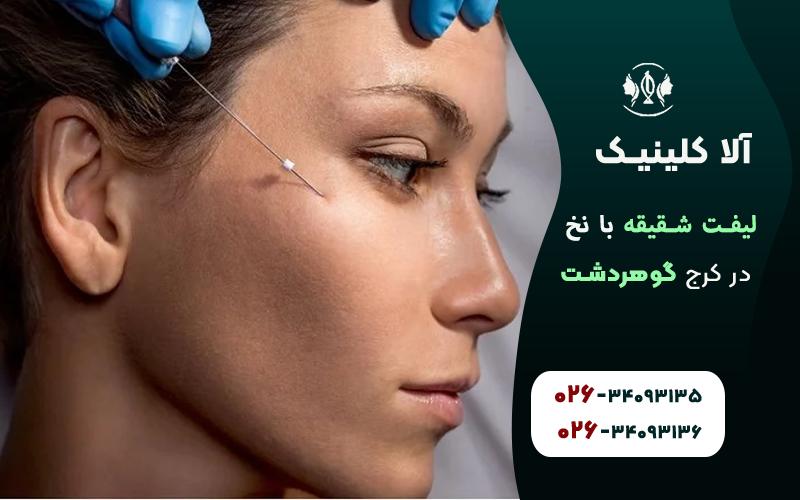 مزایای لیفت شقیقه با نخ