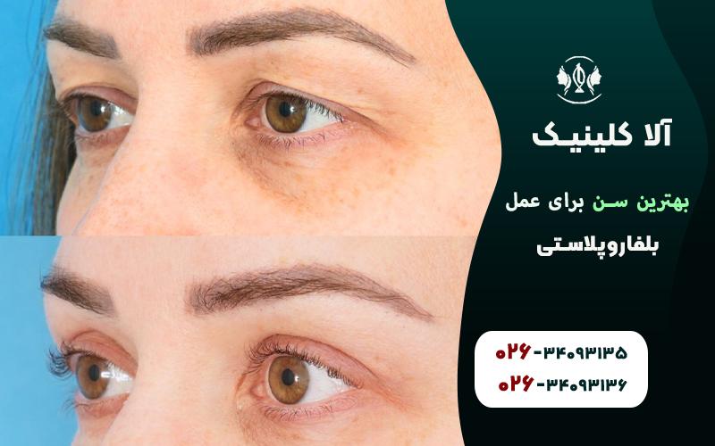 بهترین سن برای عمل بلفاروپلاستی چه سنی است