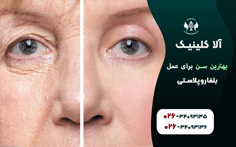 بهترین سن برای عمل بلفاروپلاستی چه سنی است
