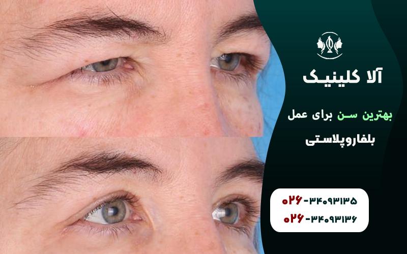 عمل بلفاروپلاستی قبل و بعد