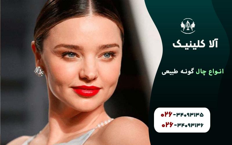انواع چال گونه طبیعی