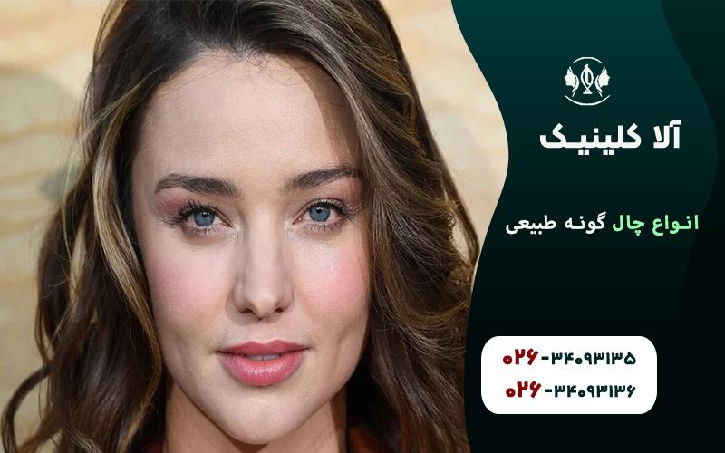 چال گونه دوگانه