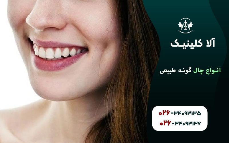 انواع چال گونه طبیعی