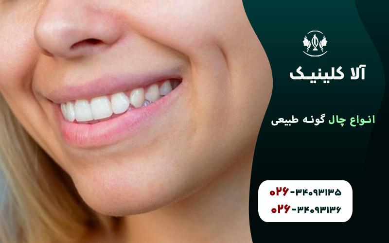 انواع چال لپ طبیعی