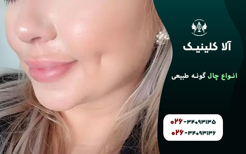 چال گونه یک گانه