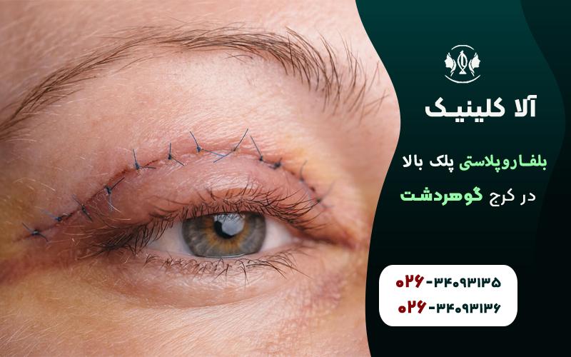 بلفاروپلاستی پلک بالا در کرج