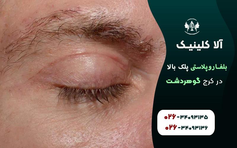 بلفاروپلاستی پلک بالا