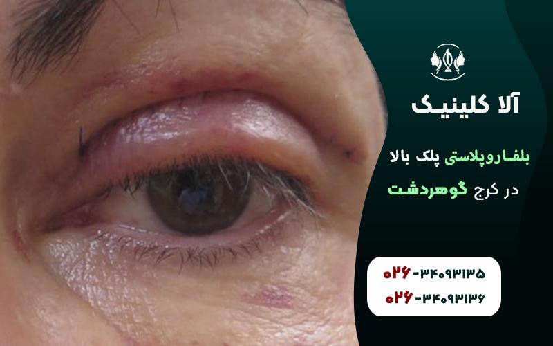 بلفاروپلاستی پلک بالا در کرج گوهردشت