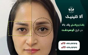 بلفاروپلاستی پلک بالا