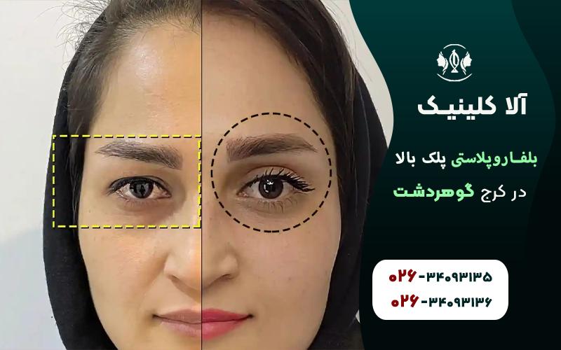 بلفاروپلاستی پلک بالا