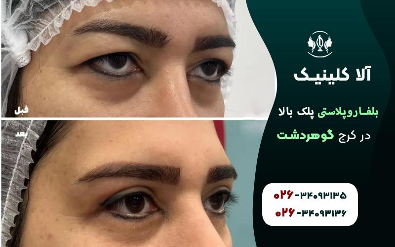 بلفاروپلاستی پلک بالا در کرج قبل و بعد