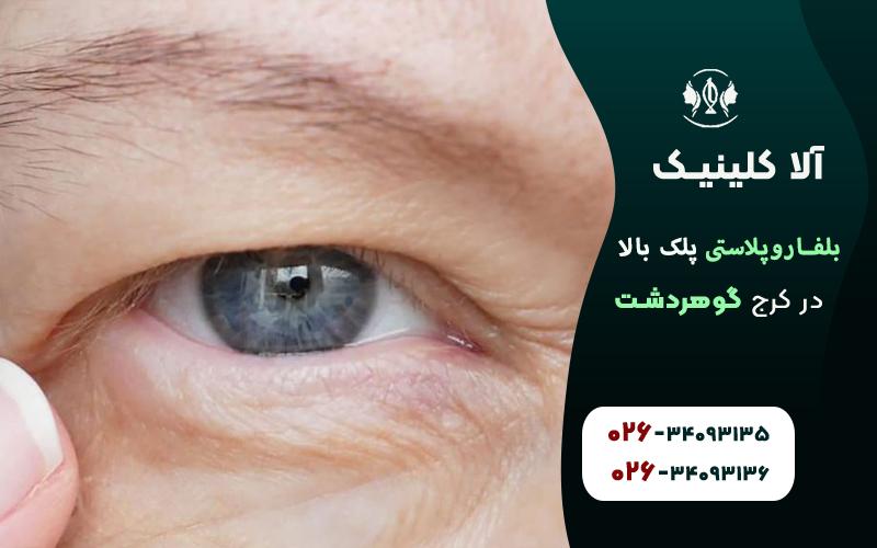 بلفاروپلاستی پلک بالا در کرج