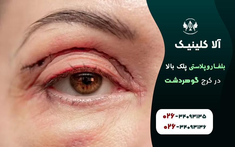 بلفاروپلاستی پلک بالا در کرج