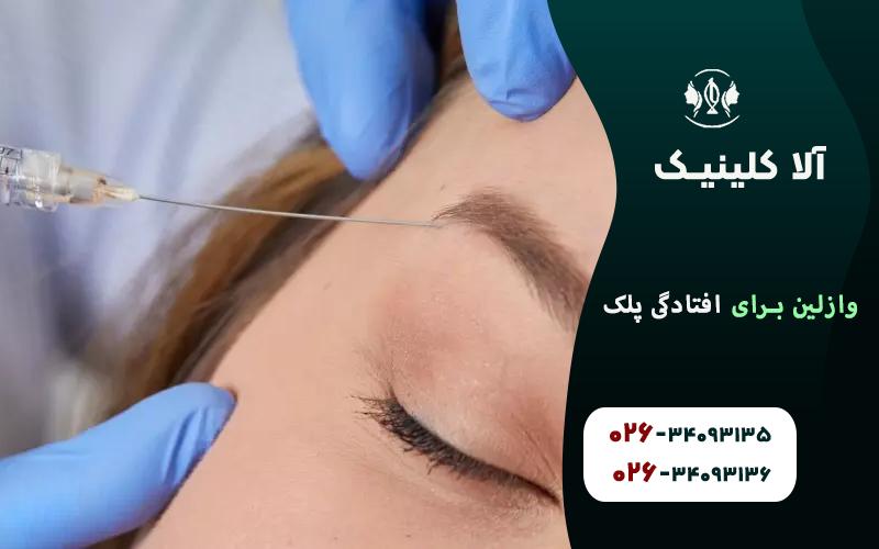 رفع افتادگی پلک با تزریق بوتاکس