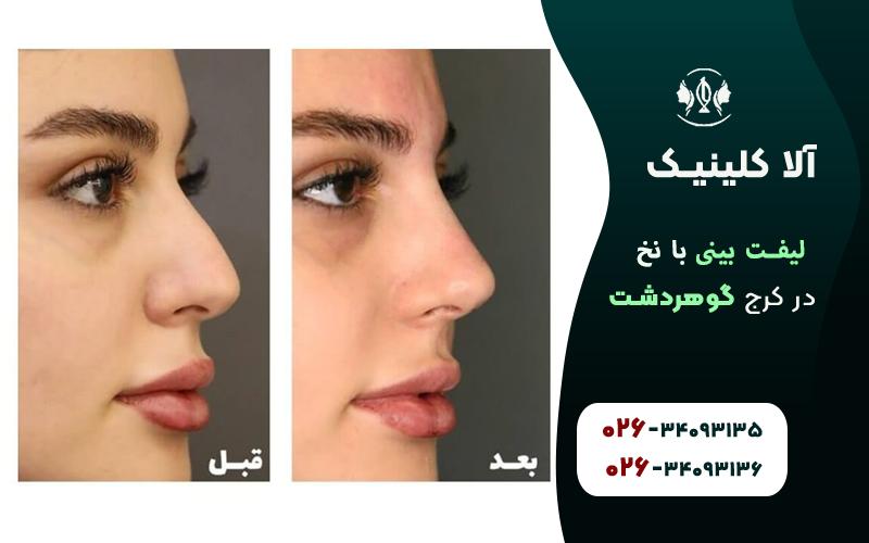 لینفت بینی در کرج