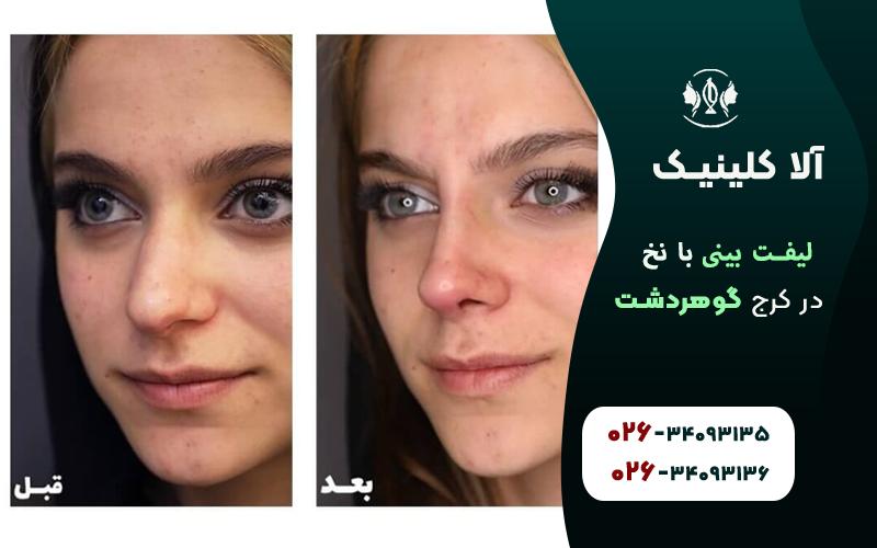 لینفت بینی با نخ قبل و بعد