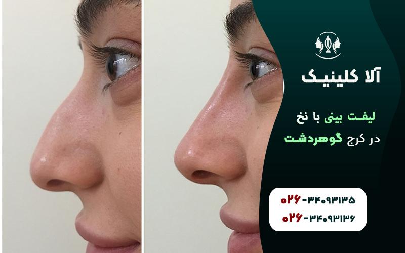 لیفت بینی
