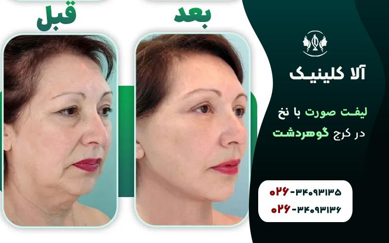 نحوه انجام لیفت صورت با نخ در کرج