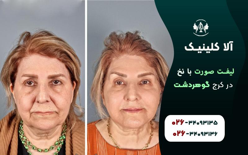 لیفت صورت با نخ قبل و بعد