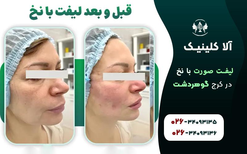 لیفت صورت با نخ در کرج