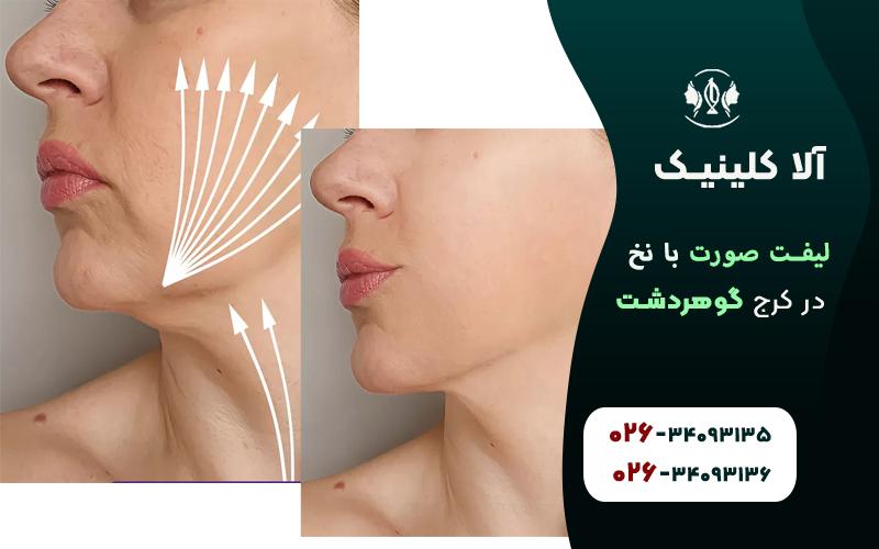 لیفت صورت با نخ در کرج