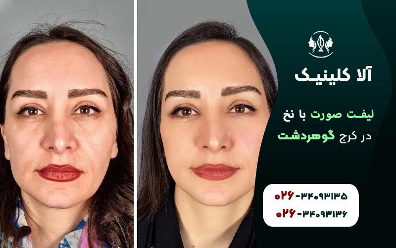لیفت صورت با نخ در کرج قبل و بعد