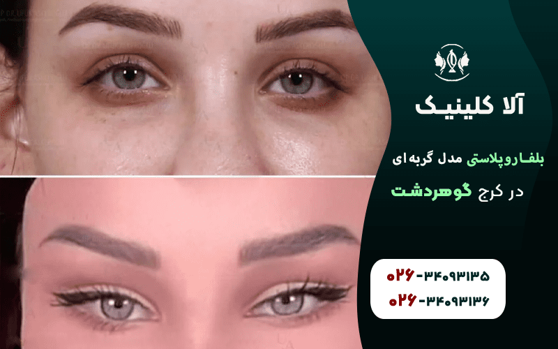 بلفاروپلاستی مدل گربه ای قبل و بعد