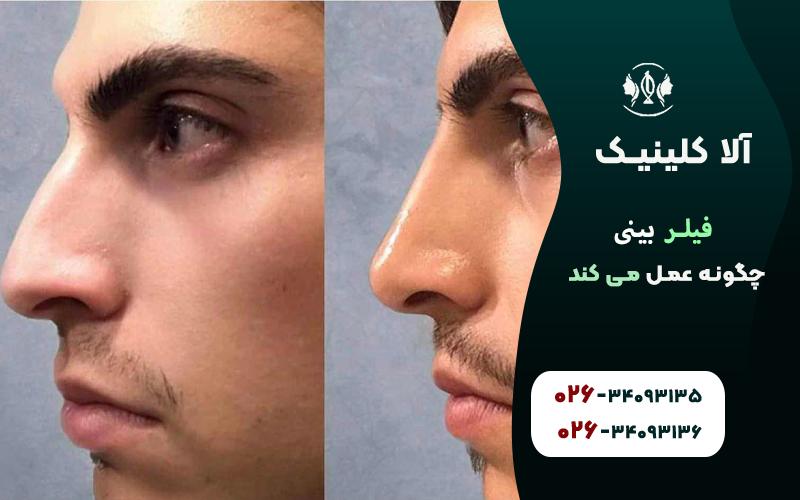 نحوه تزریق فیلر بینی