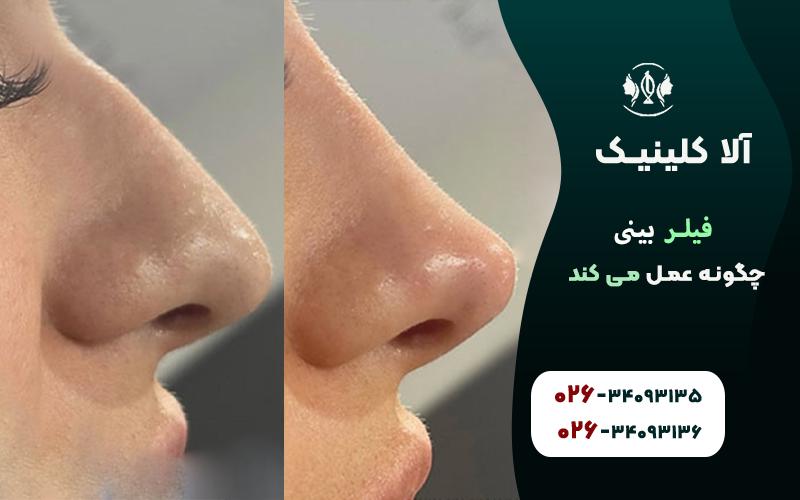 فیلر بینی چگونه عمل می کند