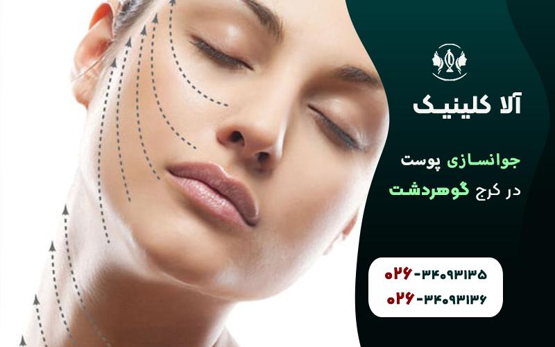 جوانسازی پوست با نخ در کرج