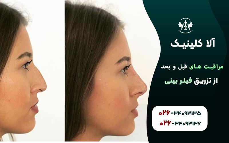 مراقبتهای مهم بلافاصله بعد از تزریق فیلر بینی