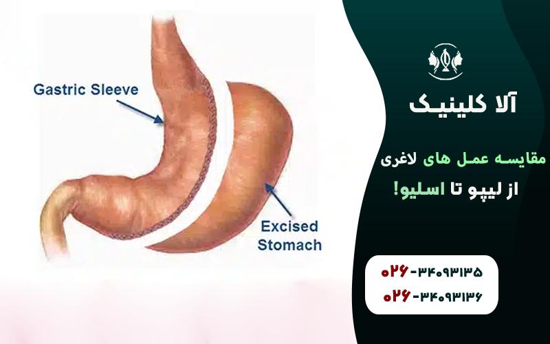 مقایسه عمل های لاغری (از لیپو تا اسلیو!)