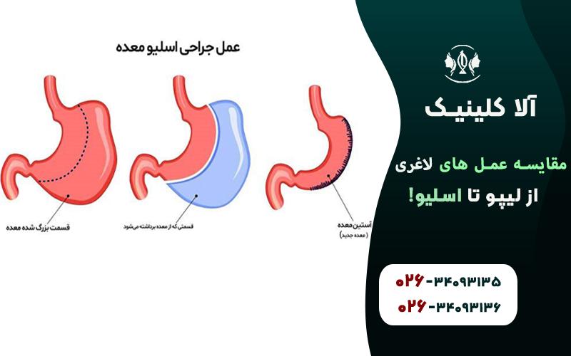 مقایسه عمل های لاغری (از لیپو تا اسلیو!)